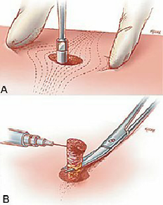 procedimentos_-_bioÌpsia_por_punch.png