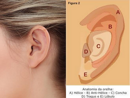 Otoplastia