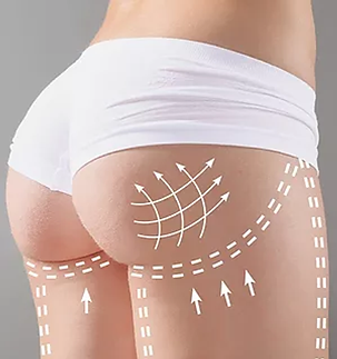 Gluteoplastia (aumento do bumbum)
