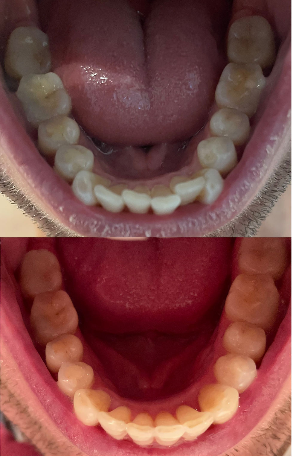 Lower before after 4