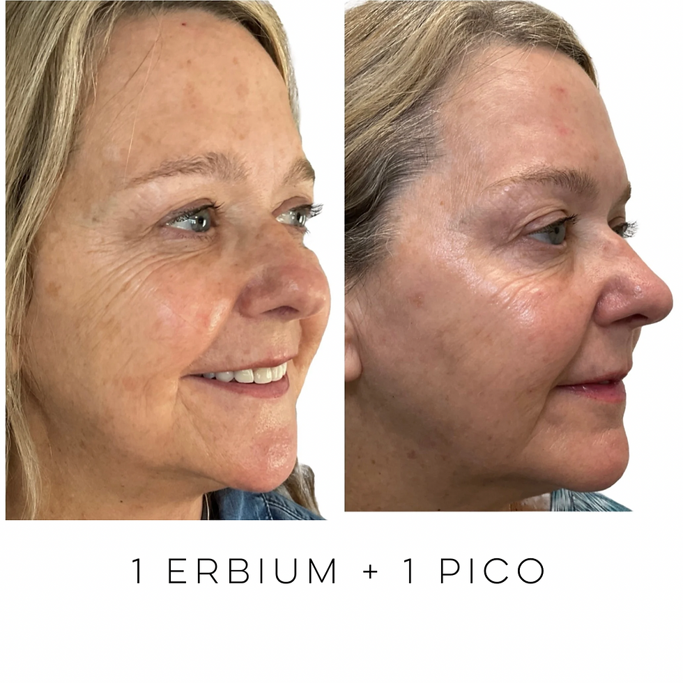 louisville patient shown before and after erbium laser treatment at skin treats- displaying less brighter and tighter skin