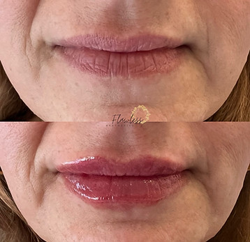 chattanooga patient before and after lip filler for a more youthful appearance