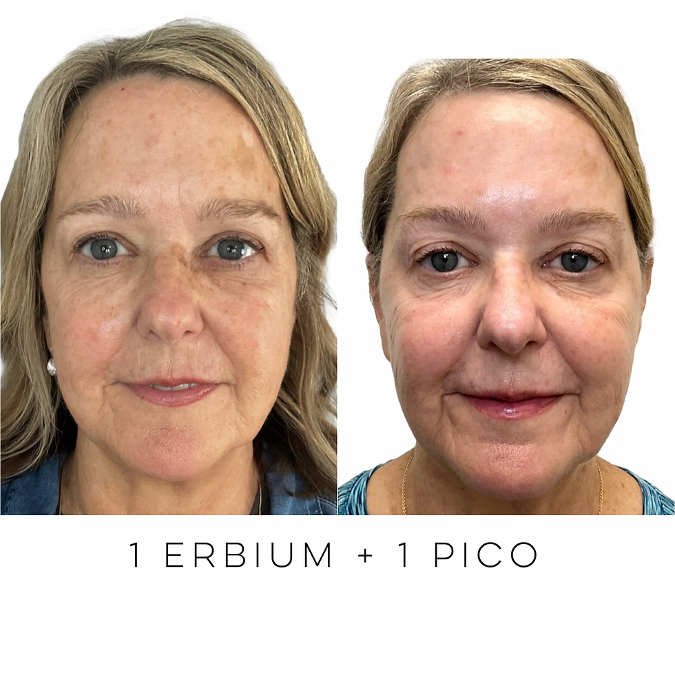 louisville patient shown before and after erbium combined with pico laser skin treatment