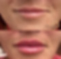 patient shown before and after lip filler injections