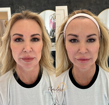 Everesse Laser RF Skin Tightening chattanooga patient before and after treatment