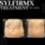 patient before and after receiving sylfirm rf microneedling to firm tummy skin