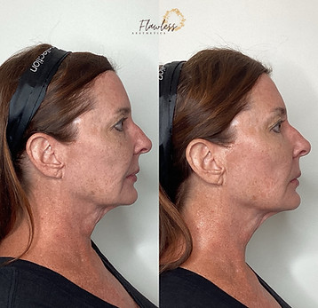 everesse non surgical skin tightening chattanooga patient before and after