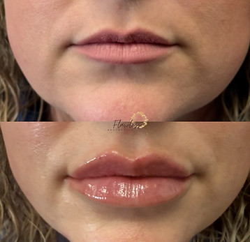 lip fillers chattanooga patient before and after with natural results