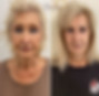 sylfirm microneedling before-and-after photo