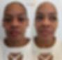before and after of chin filler patient in chattanooga
