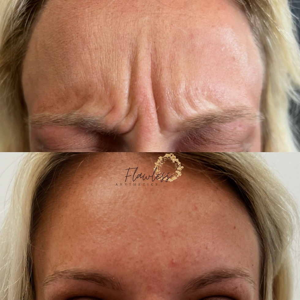 chattanooga patient shown before and after receiving xeomin for her forehead lines