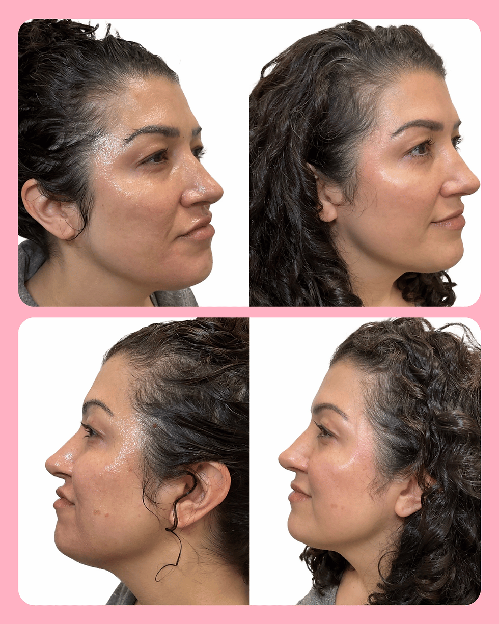 louisville patient before and after erbium laser skin resurfacing at skin treats