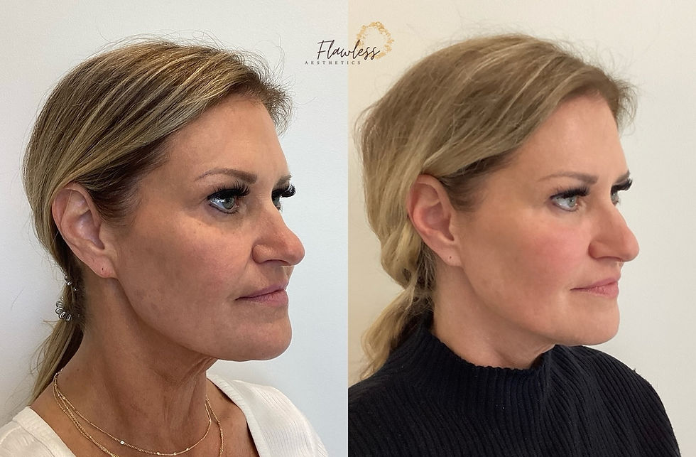 chattanooga patient before and after dissolving filler and correcting previous injections from another injector