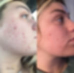 BBL laser before and after in Chattanooga