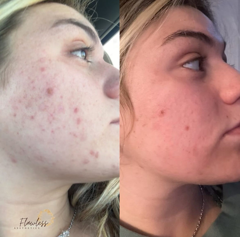 BBL laser before and after in Chattanooga