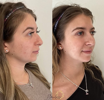 chattanooga patient before and after facial balancing and chin filler