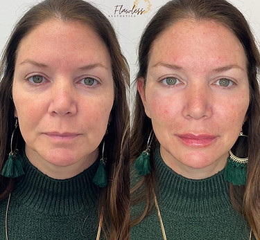 injectable filler results before and after photo