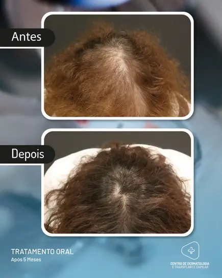Tratamento Oral para alopécia com o resultado apresentado após 5 Meses