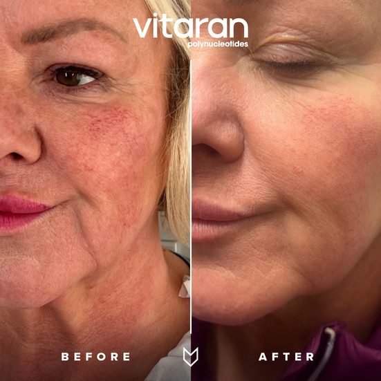 vitaran before and after