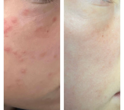 Acne treatments Beckenham