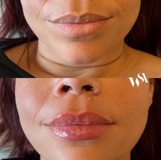 natutral lip filler results