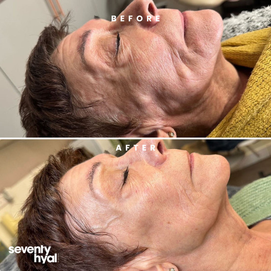 seventy hyal results