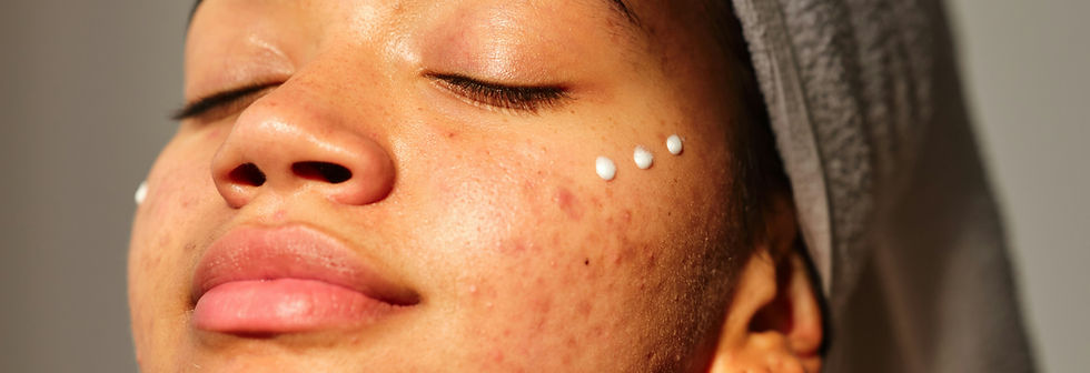 acne treatments northampton