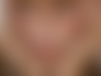 Non-Surgical Facelift