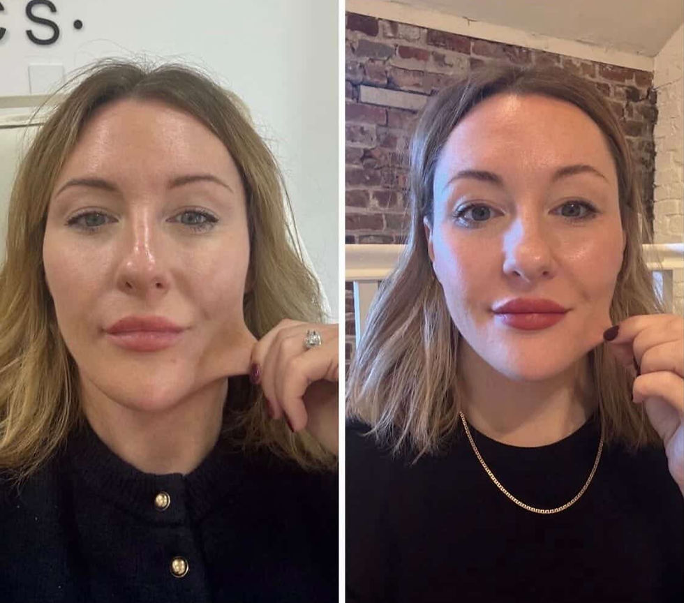 sculptra skin tightening results