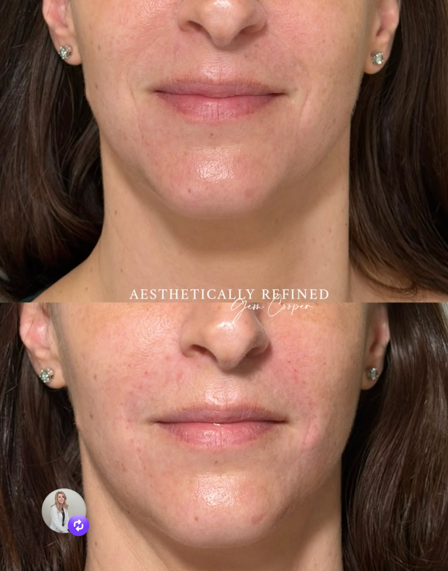 smile line treatment Newbury