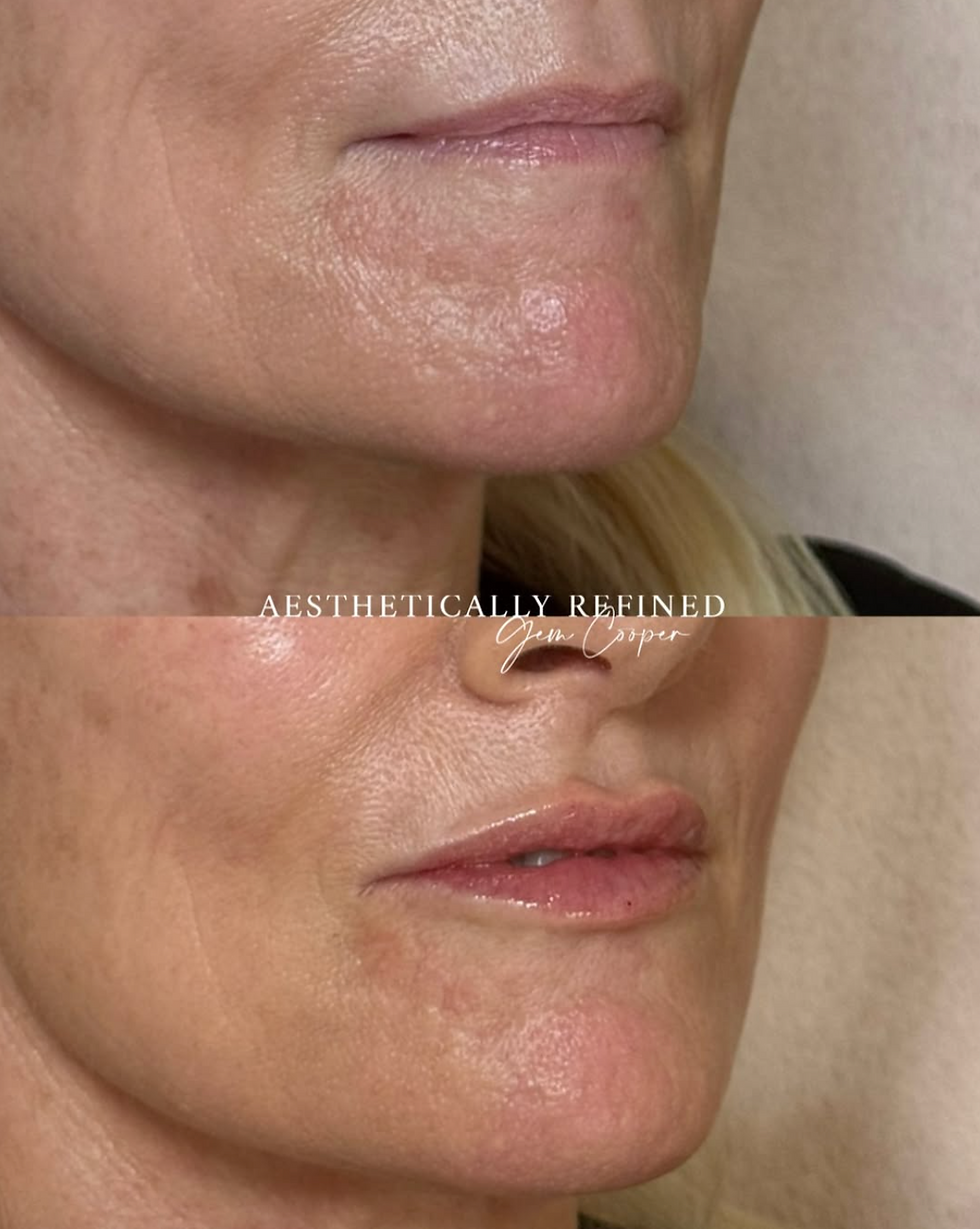lip filler results Berkshire
