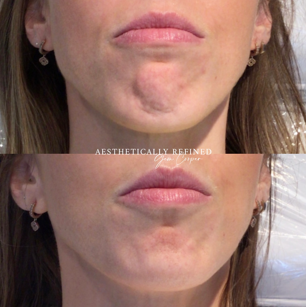chin botox results