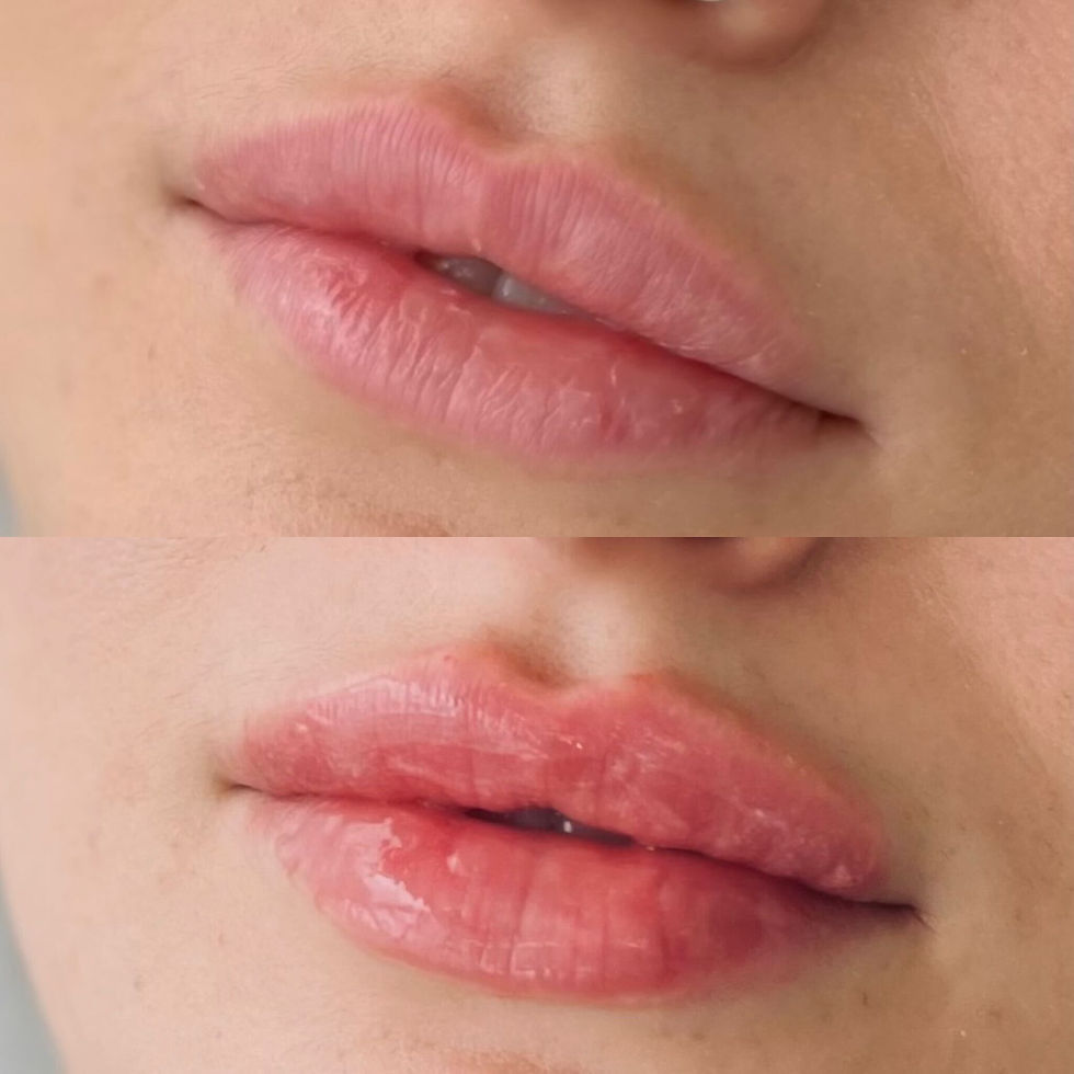 natural lip filler near me
