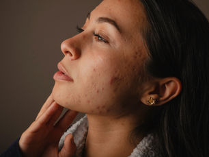 post pill acne