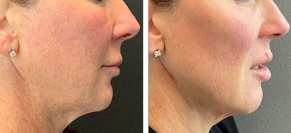 sculptra results