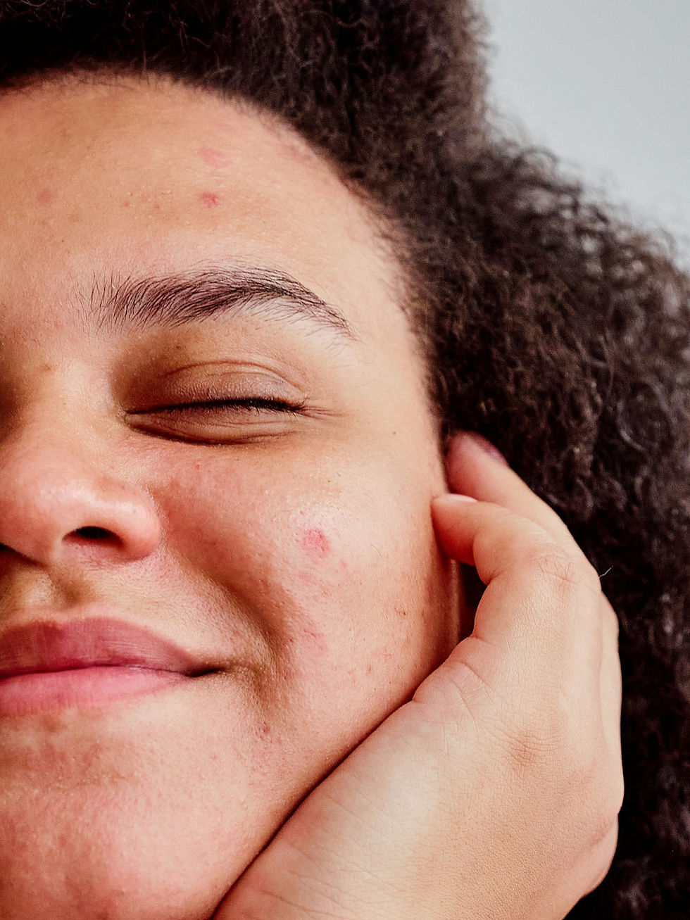 teen skin treatments Scotland