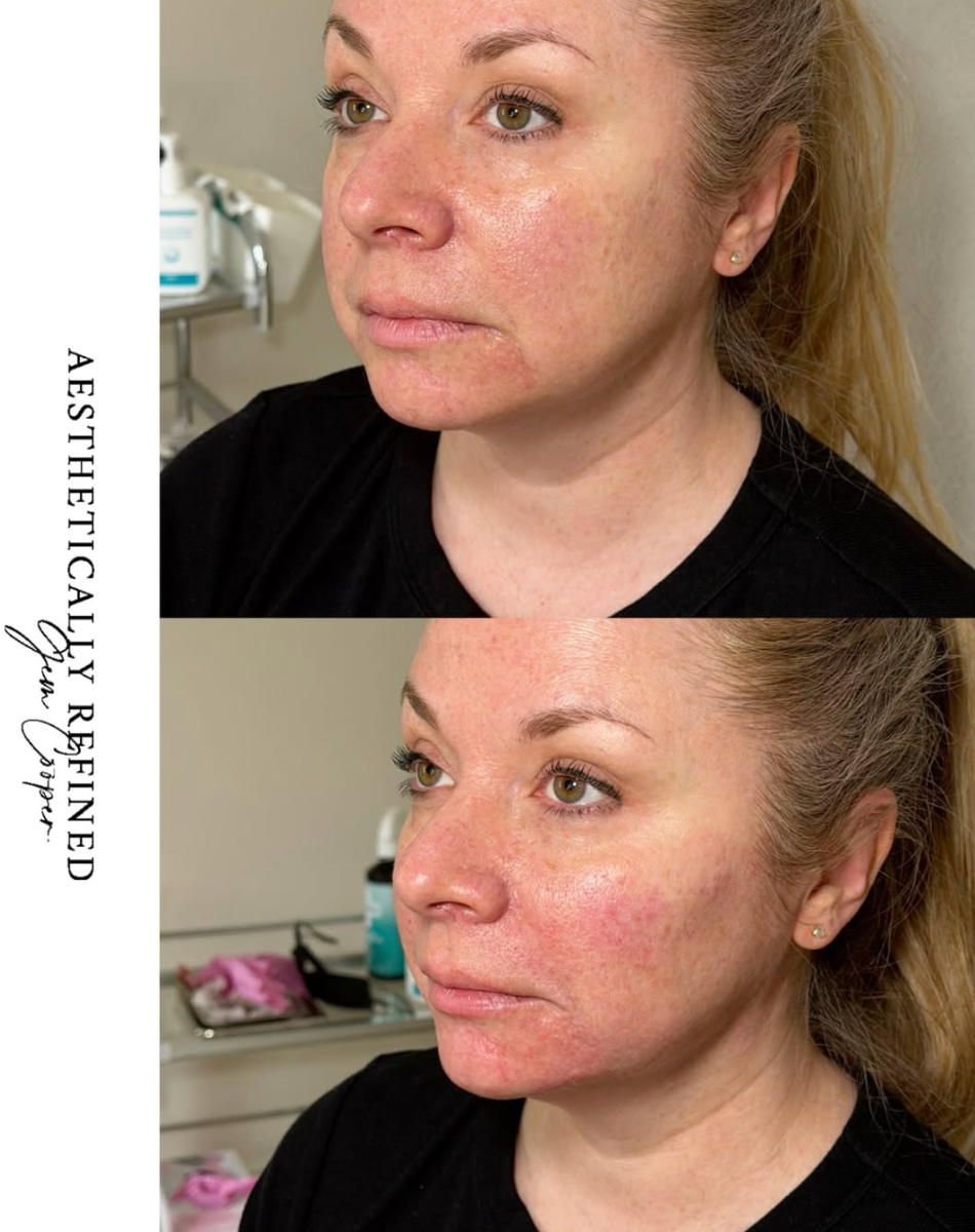 cheek filler Berkshire