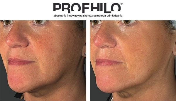 skin boosters before and after