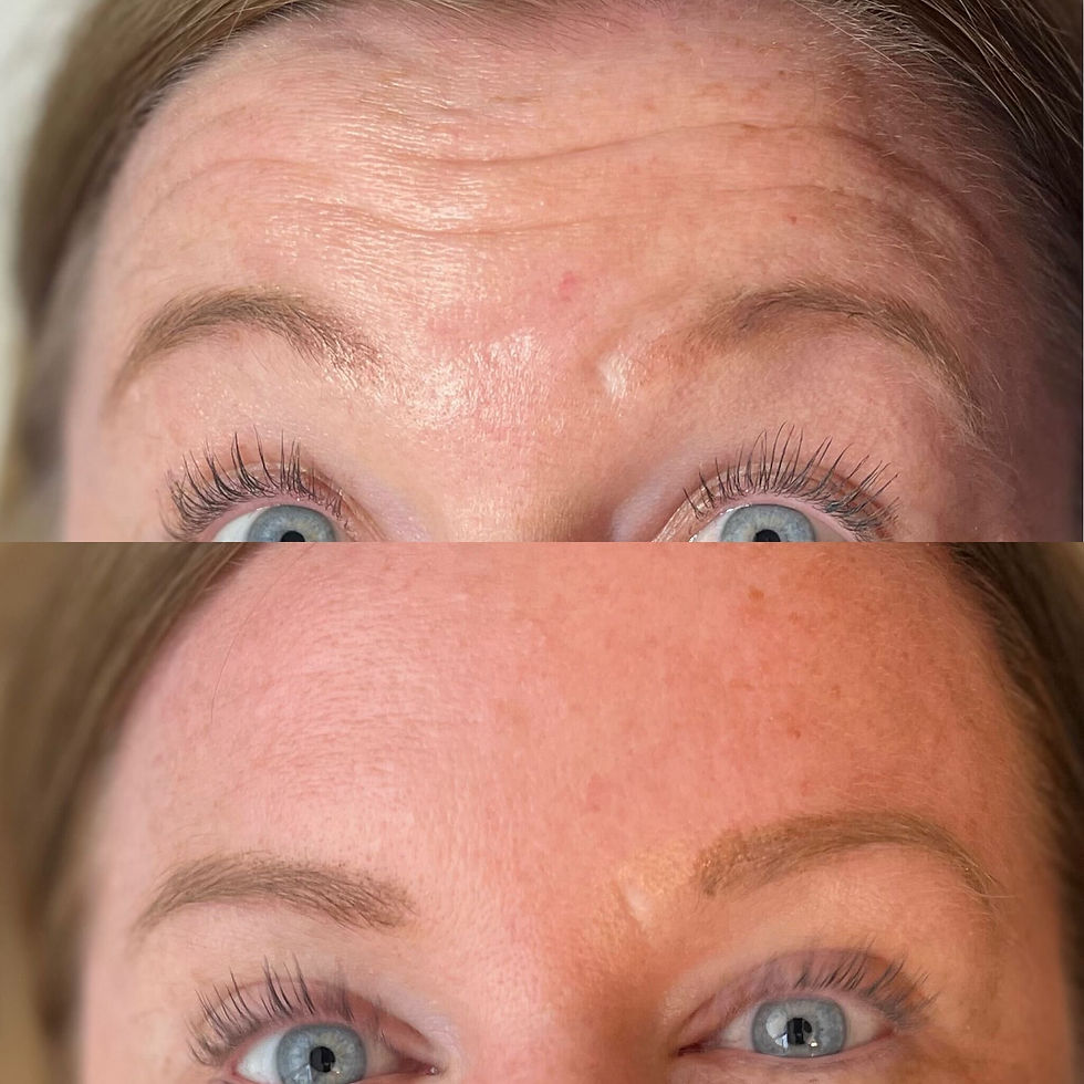 natural botox uk