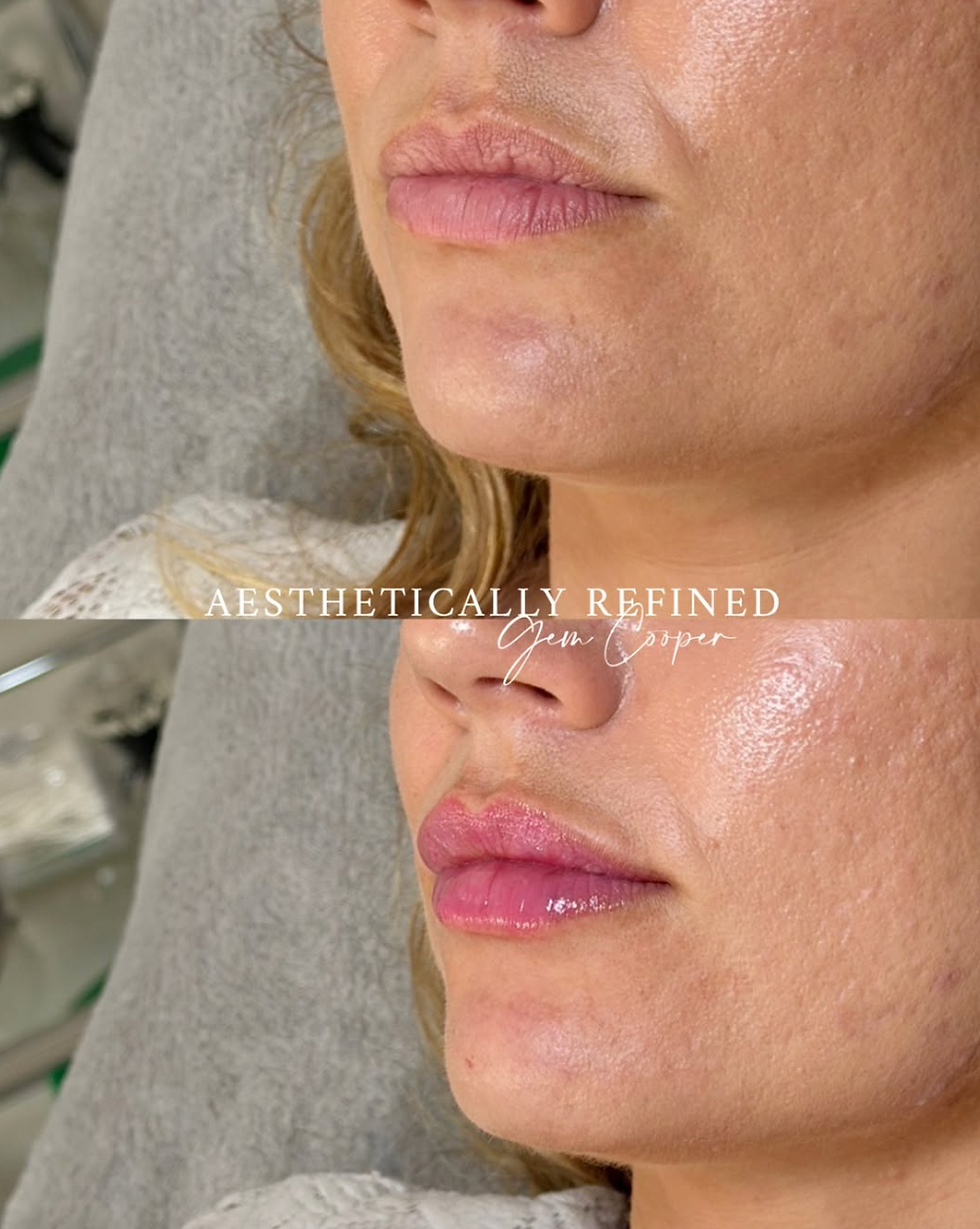 thin lips lip filler results