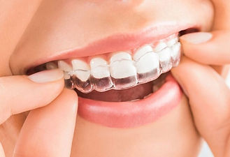 what-is-invisalign.jpg