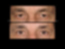 Blefaroplastia 4