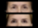 Blefaroplastia 2