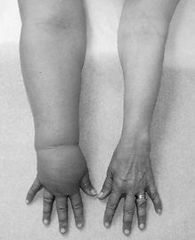 Cellulitis-in-right-arm-of-patient-with-