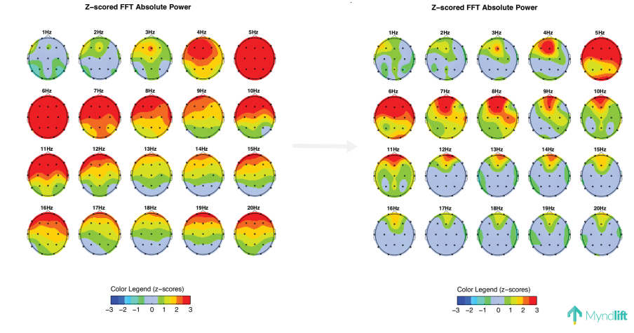 qEEG brain map before and after daily use of Myndlift