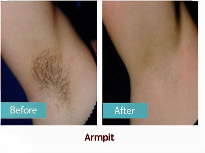 laser hair removal near me