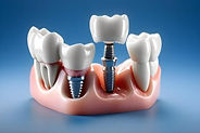 implants_edited.jpg