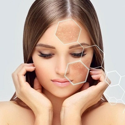 How Does Sun Exposure Affect Melasma?