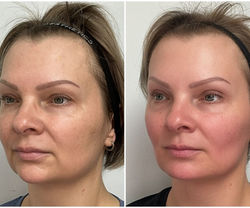 Dermal Filler Before & After 4