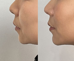 Dermal Filler Before & After 1